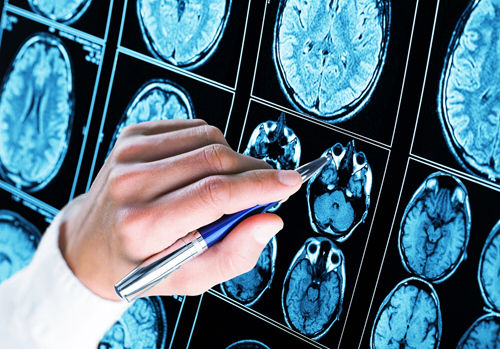 Demenza senile o morbo di Alzheimer? Conoscere le differenze